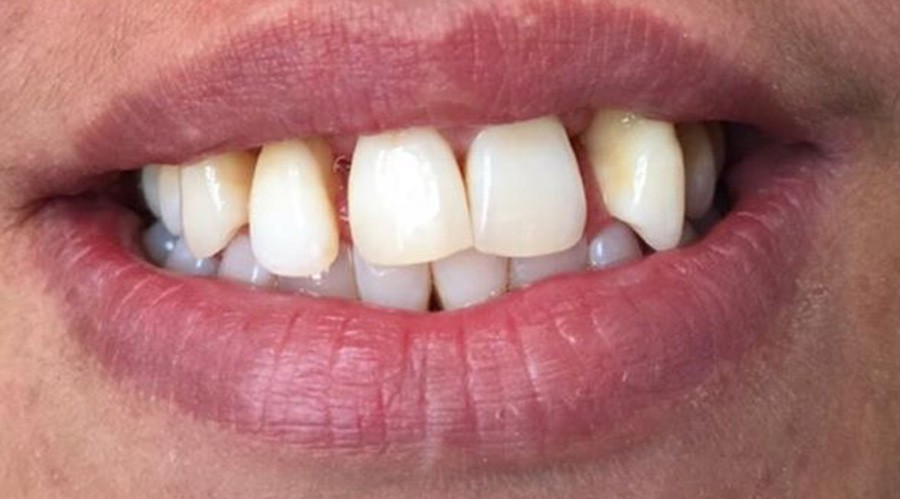 بعد تركيبات-اسنان